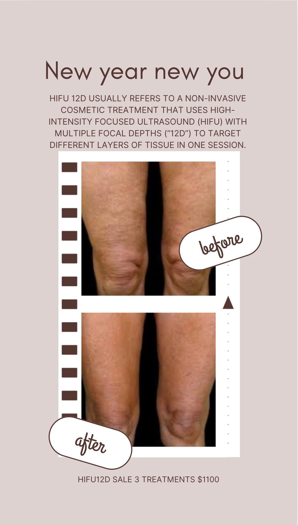 Hifu12D 3treatment pack